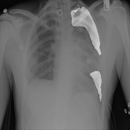 Thorax Segmentation