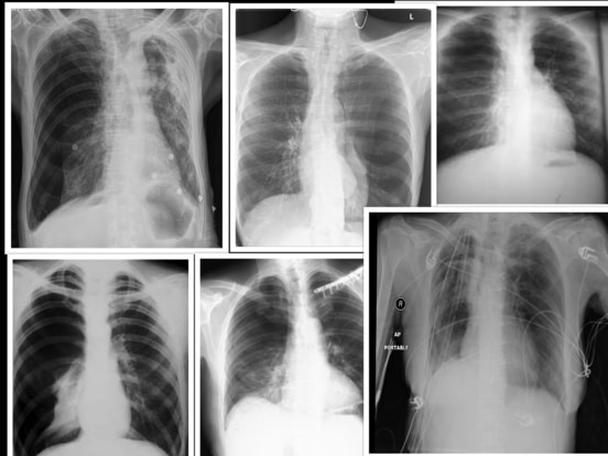 Thorax X rays collage